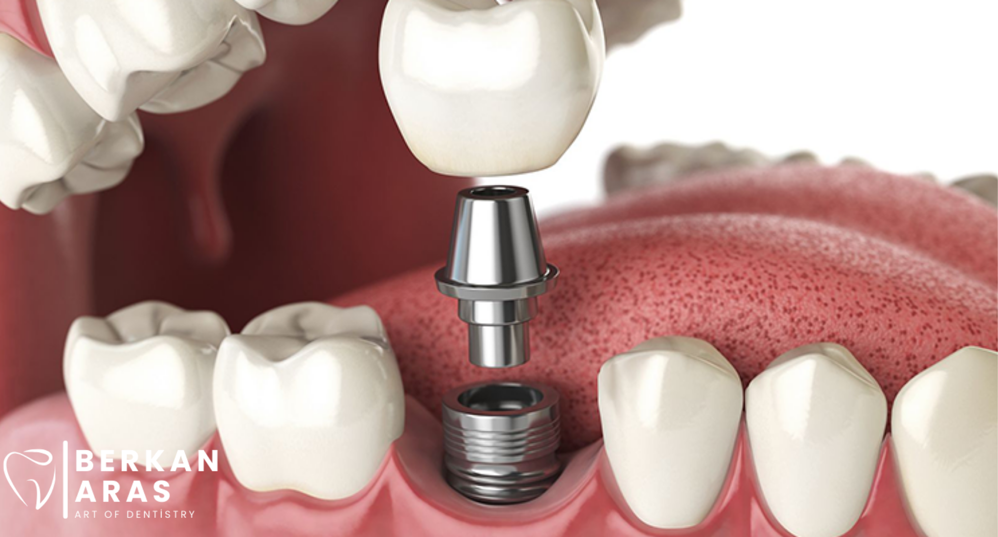 İmplant Tedavisi